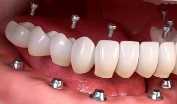 اولین دندان مصنوعی ساخته کیست؟
