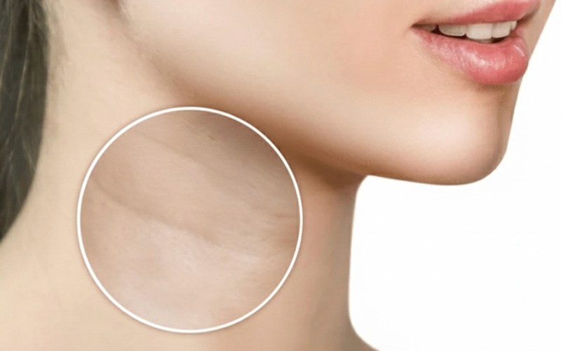 رفع خطوط گردن