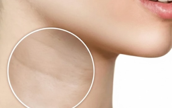 رفع خطوط گردن