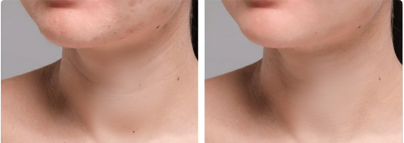 رفع خطوط گردن